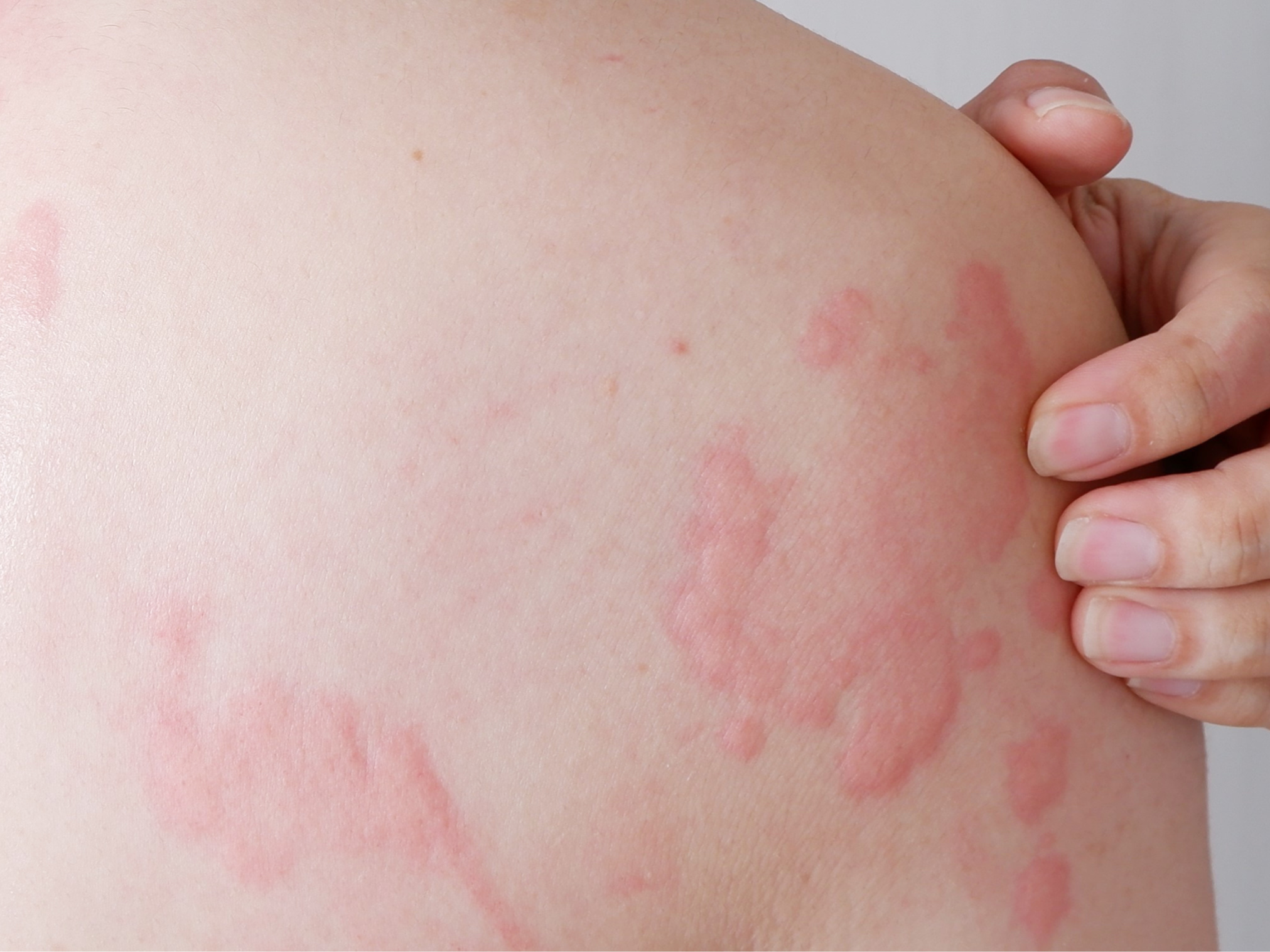 AD_EXOMEGA_ECZEMA_SILO_Eczema and hives_H3_symptoms and apparition